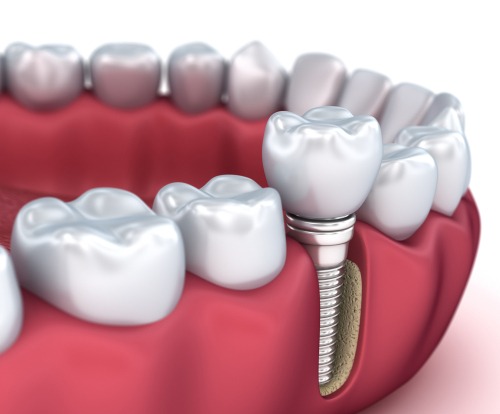 Implant Dentistry